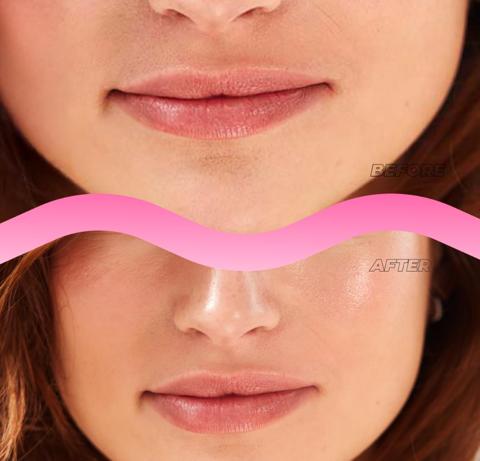 Microneedle Lip Plumping Patch